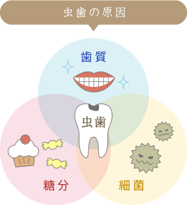 虫歯の原因「歯質」「糖分」「細菌」