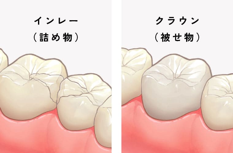 インレー（詰め物）、クラウン（被せ物）