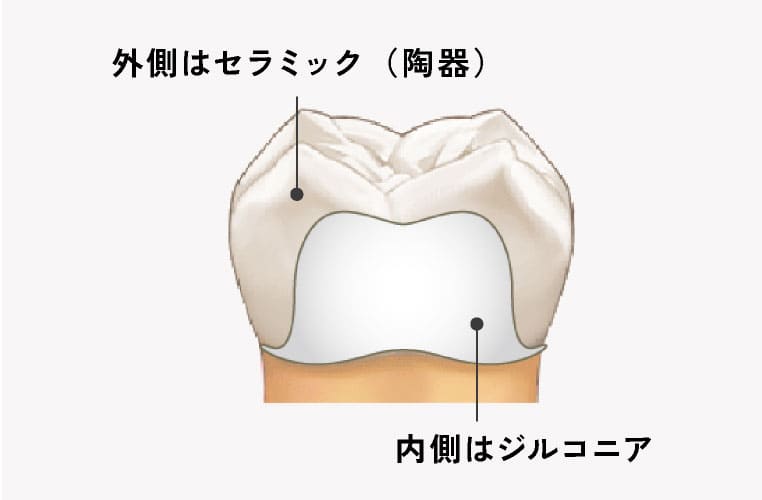 外側はセラミック（陶器）、内側はジルコニア
