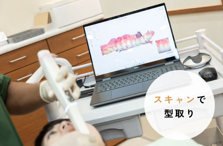 スキャンで型取り