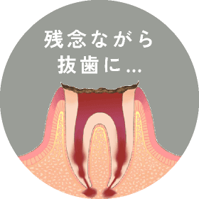 残念ならば抜歯に