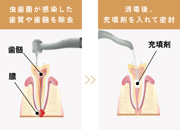 虫歯菌が感染した歯質や歯髄を除去 消毒後、充填剤を入れて密封
