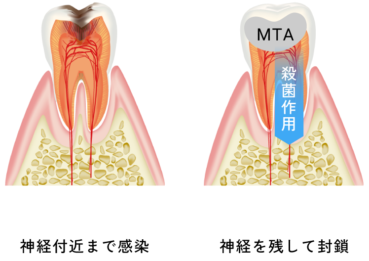 深く進行した虫歯(神経付近まで感染)を断髄する MTA+補綴により神経を残して封鎖