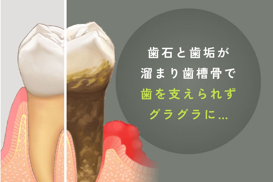 歯石や歯垢が溜まり歯槽骨で歯を支えられずグラグラに…