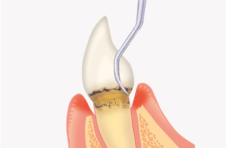 エムドゲインの塗布
