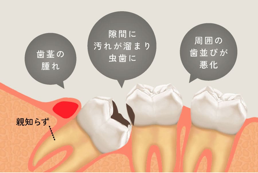 「親知らず」歯茎の腫れ・隙間に汚れが溜まり虫歯に・周囲の歯並びが悪化